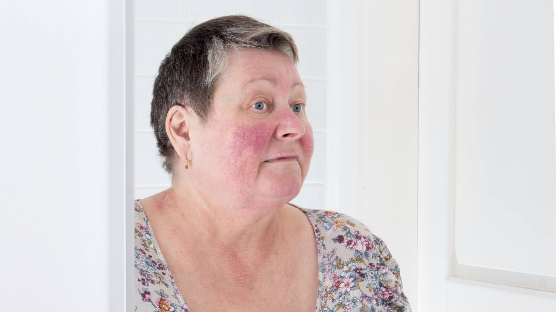 Can LED Light Therapy help Rosacea? - Neo Elegance