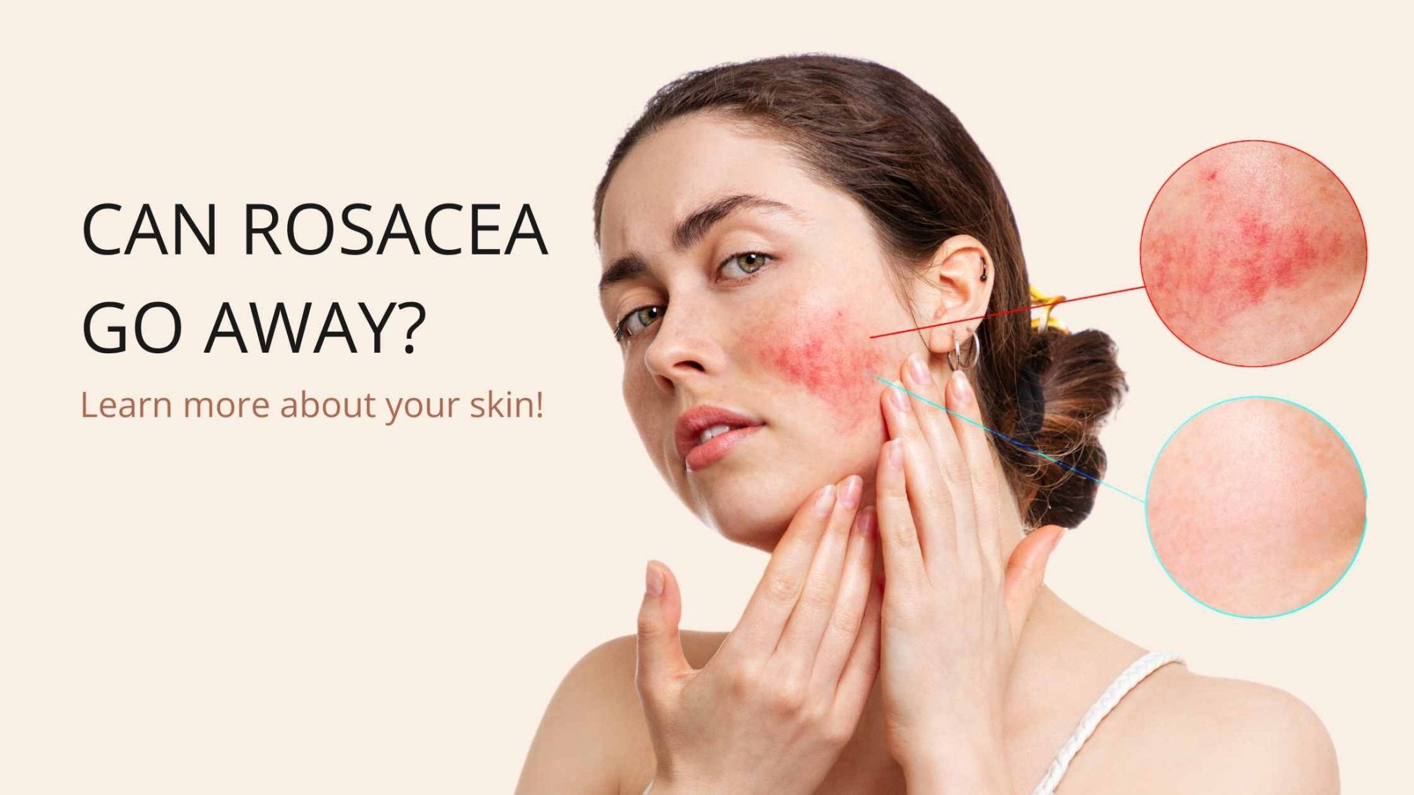 Can Rosacea Go Away? Understanding your Rosacea - Neo Elegance
