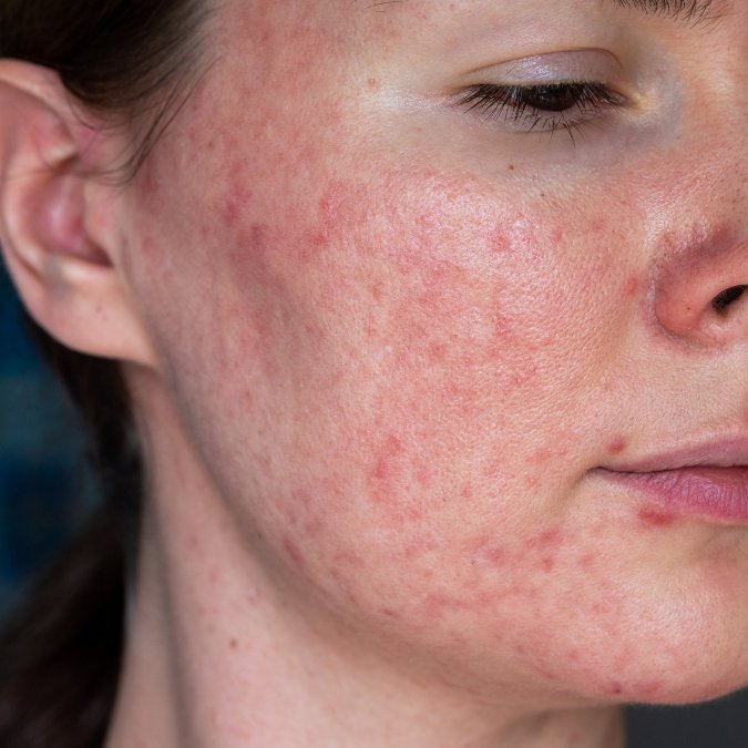 Does Red Light Therapy help Rosacea? - Neo Elegance
