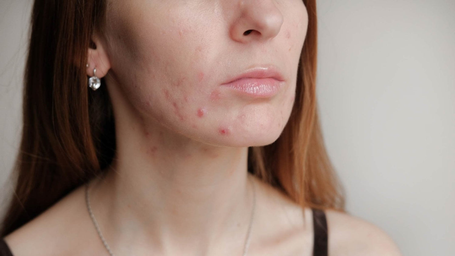 How does LED Light Therapy work for Acne? - Neo Elegance