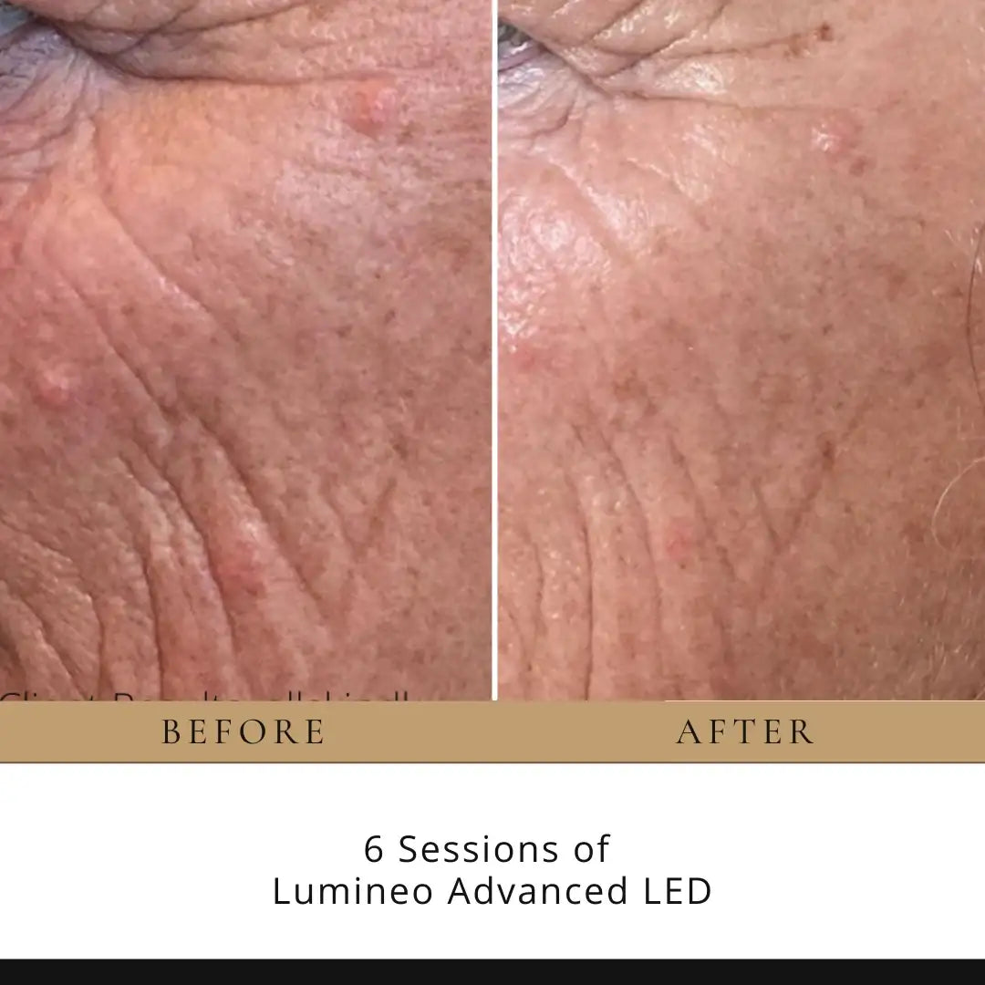 Lumineo Professional LED Light Therapy Panel