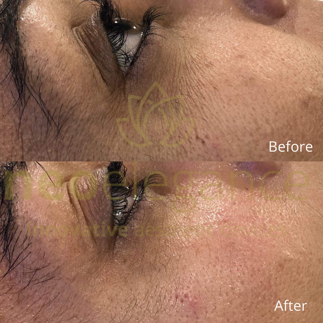 LumiPro Advanced Facial Toning Device - Neo Elegance Ltd