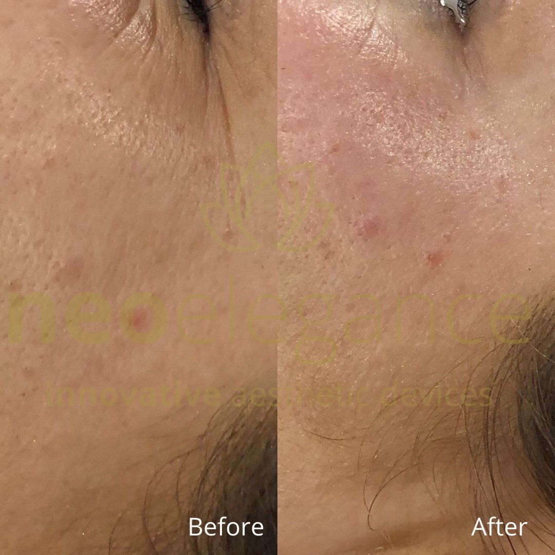 LumiPro Advanced Facial Toning Device - Neo Elegance Ltd