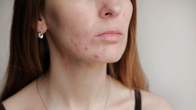 How does LED Light Therapy work for Acne?