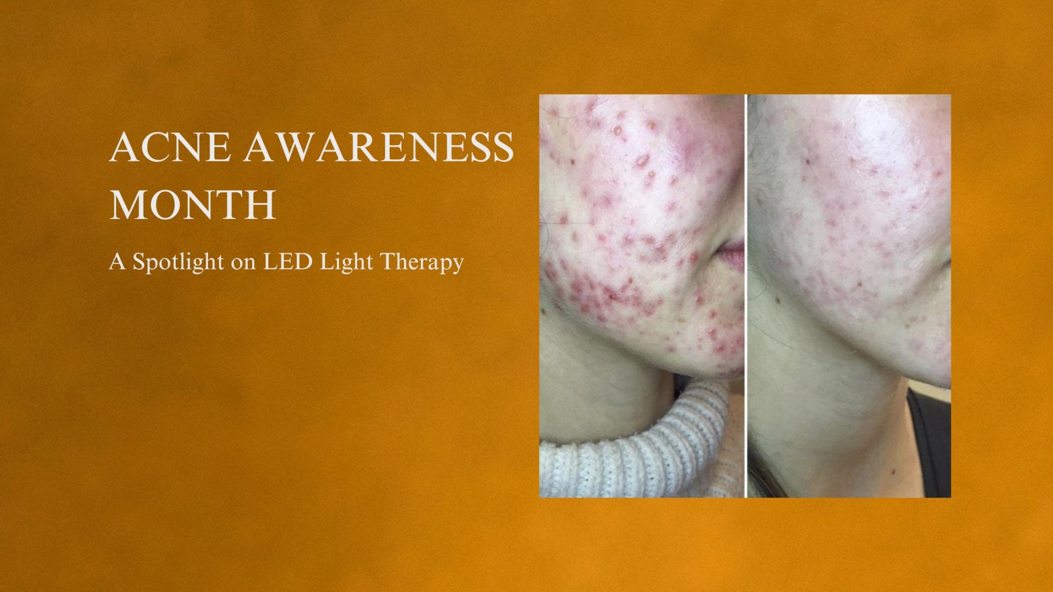 Acne Awareness Month: Understanding Acne and Innovative Treatments- A Spotlight on LED Light Therapy - Neo Elegance Ltd