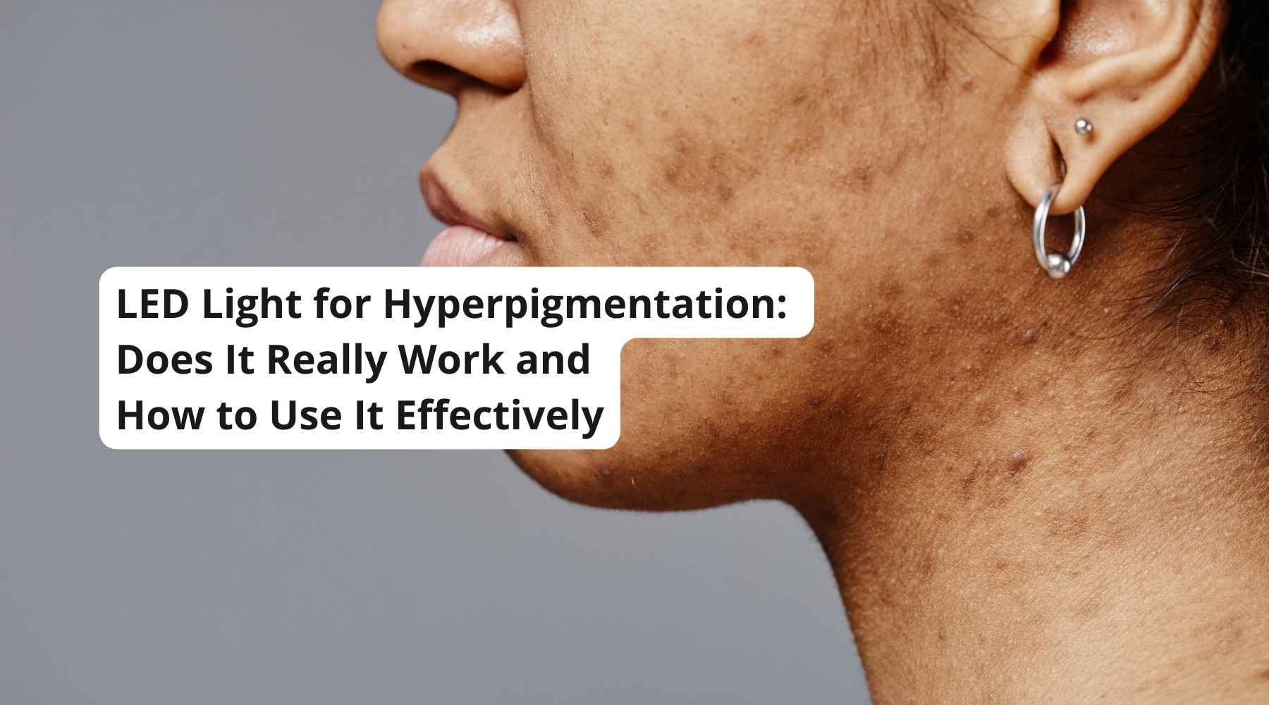 LED Light for Hyperpigmentation: Does It Really Work and How to Use It Effectively - Neo Elegance