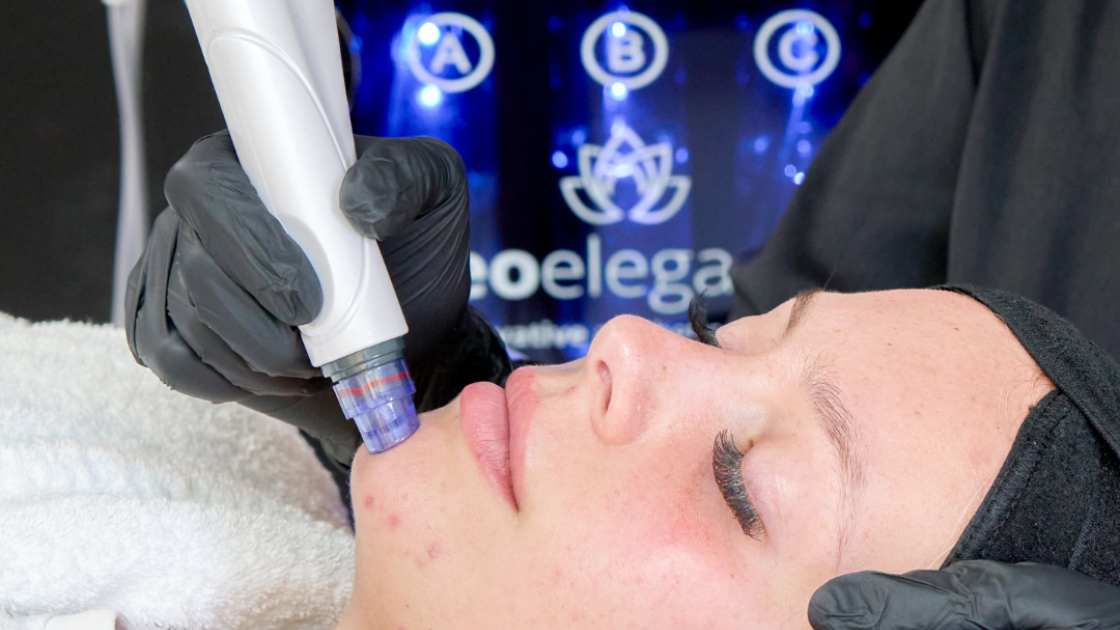 Load video: hydrafacial